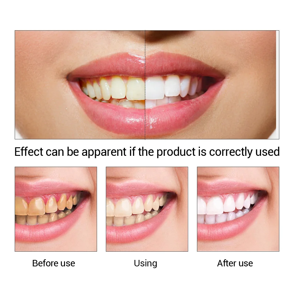 FTEENPLY poudre d'essence de b - Teeth Whitening Procedure avis et prix