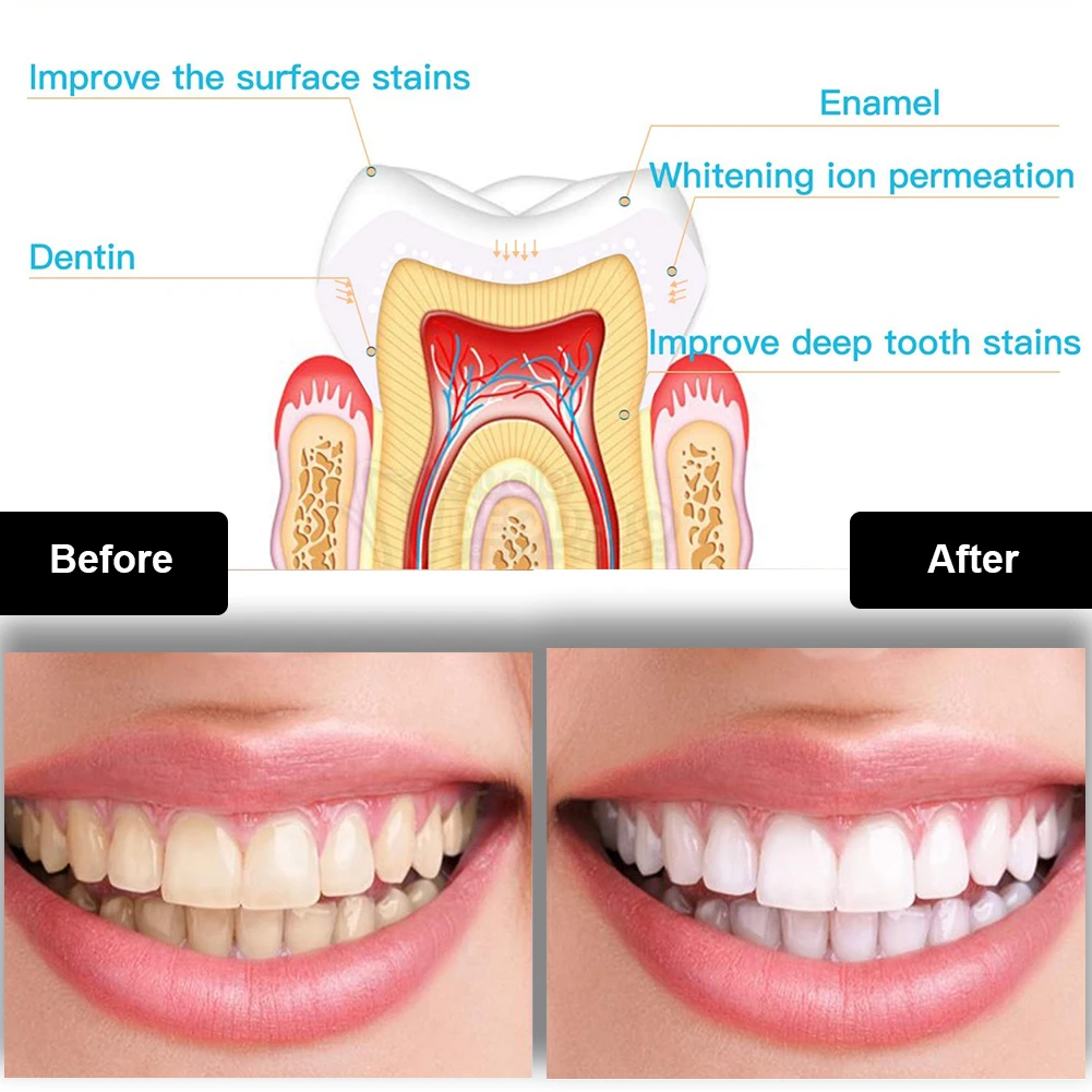 Kit de blanchiment des dents d - Teeth Whitening Procedure avis et prix