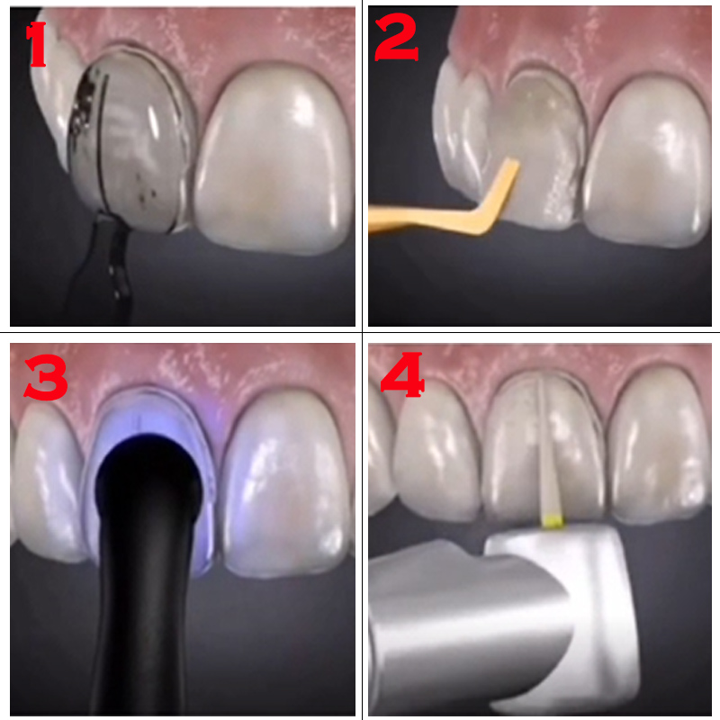 Moule de placage dentaire auto - Teeth Whitening Quick avis et prix